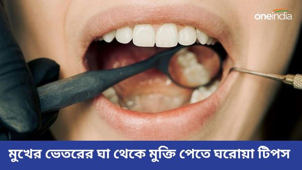 মুখের ভেতর ঘায়ের জ্বালা, ব্যথায় কষ্ট পাচ্ছেন, মুক্তি মিলবে এই ঘরোয়া উপায়ে