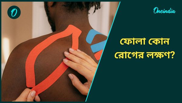 শরীরের এই অংশগুলির ফোলাভাব এড়িয়ে যাবেন না, কোন গুরুতর রোগের লক্ষণ এগুলি?