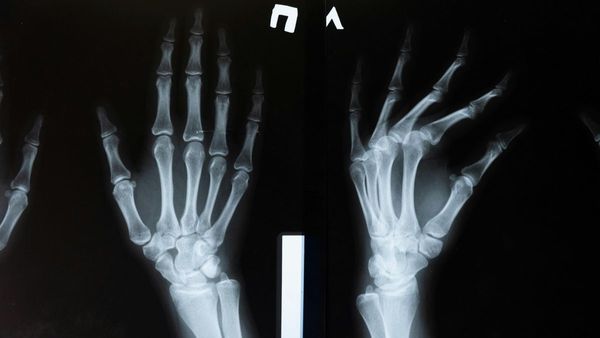 মাত্র তিন মিনিটেই জুড়বে ভাঙা হাড়, চিনা গবেষকদের উদ্ভাবনে হইচই চিকিৎসা জগতে