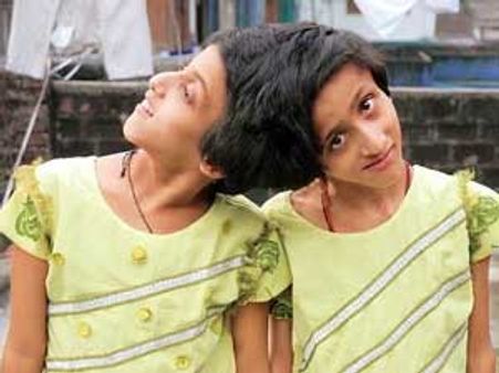 સુપ્રિમ કોર્ટનો મહત્વનો ચૂકાદો, જોડિયા બહેનોનું નહીં થાય ઓપરેશન