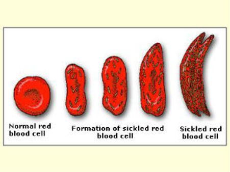 સિકલ સેલ એનિમિયા સોસાયટીની રચનામાં ગુજરાત પ્રથમ