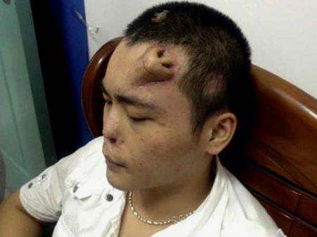 ચીનમાં ડોક્ટરે દર્દીના માથા પર ઉગાડી દીધું નવું નાક!!!