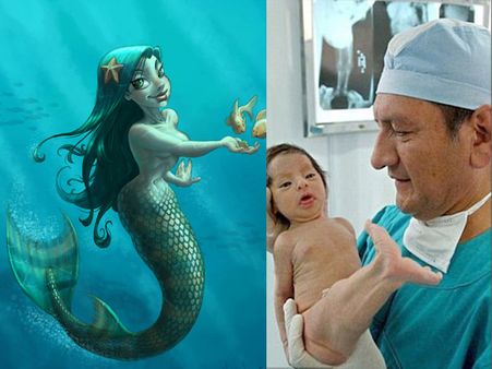 જલપરી હોય છે કે નહીં, ડોક્ટરોએ રહસ્ય પરથી ઊઠાવ્યો પરદો!!