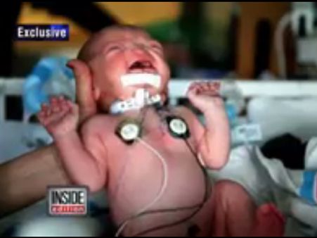 શ્વાસ લેવા માટે ગળામાં છીદ્ર