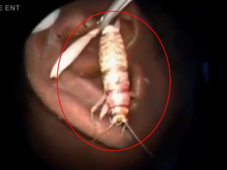 Video: આ વ્યક્તિના કાનમાંથી નિકાડવામાં આવ્યો જીવતો કિડો
