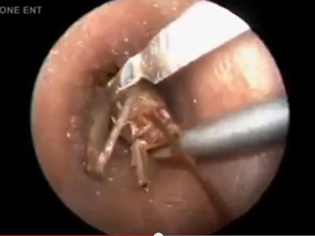 કિડાને પકડ્યો