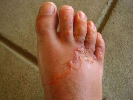 પગમાં ફરી રહેલો આ કૃમિ પગમાં ફરી રહેલો આ કૃમિ