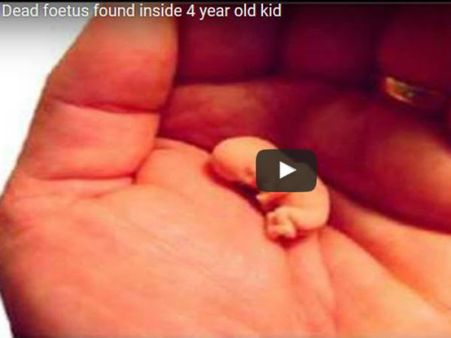 માત્ર ચાર વર્ષનું બાળક પ્રેગનેન્ટ, તબીબોઓ પેટમાંથી કાઢ્યુ મૃત ભૃણ