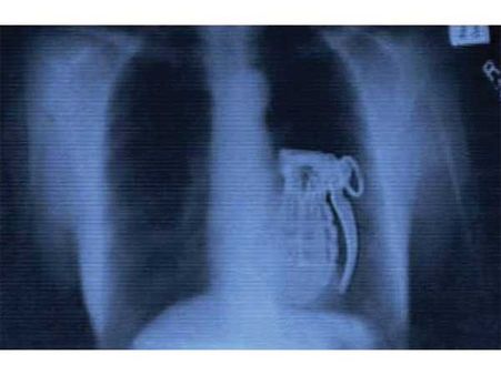 હેન્ડ ગ્રેનેડ હેન્ડ ગ્રેનેડ