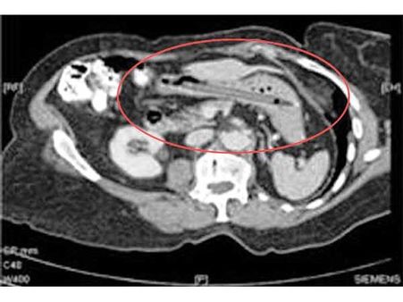 25 વર્ષથી પેટમાં પેન 25 વર્ષથી પેટમાં પેન