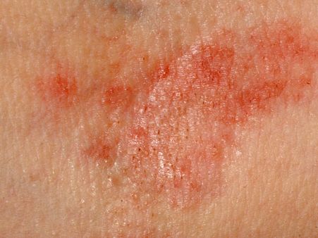 ફંગલ ઇન્ફેક્શન