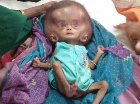 વલસાડથી સુરત લવાયેલા એલિયન જેવા બાળકને જોવા લોકો ઉમટ્યા 