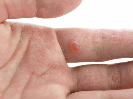 દાઝી જવા પર