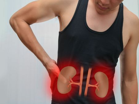 કીડની સ્ટોન 