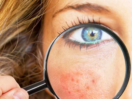 તવચાની સુજન વધારે છે 