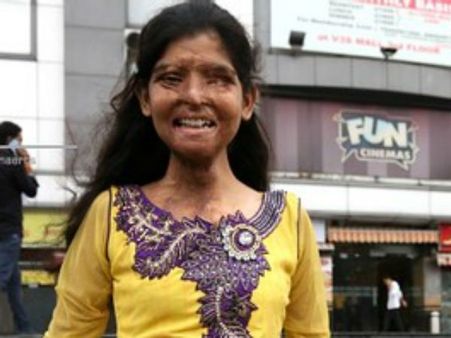 પિતરાઇ ભાઇએ જ ફેંક્યુ હતું એસિડ પિતરાઇ ભાઇએ જ ફેંક્યુ હતું એસિડ