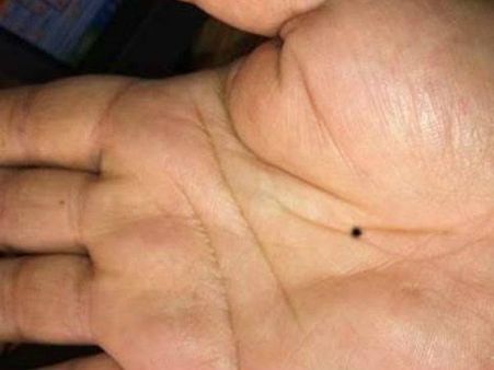 ડાબી હથેળીમાં તલ