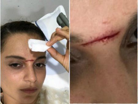 તલવાર યુદ્ધના સિન દરમિયાન થઇ ઇજા તલવાર યુદ્ધના સિન દરમિયાન થઇ ઇજા