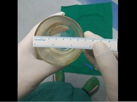 OMG : ચીની વ્યક્તિના પેટમાંથી નીકળ્યો આવડો મોટો કાચ!