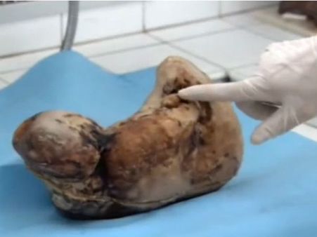 46 વર્ષ બાદ બાળકનો જન્મ 