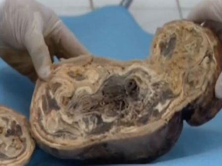 પેટમાં બાળક પથ્થર બની ગયુ. 