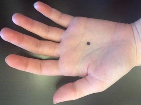 હાથ પર તલ