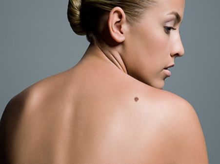 ખભા પર તલ