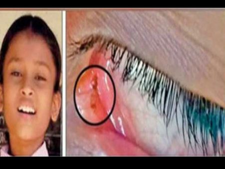 10 દિવસથી આખોમાંથી નીકળી રહી છે કીડીઓ