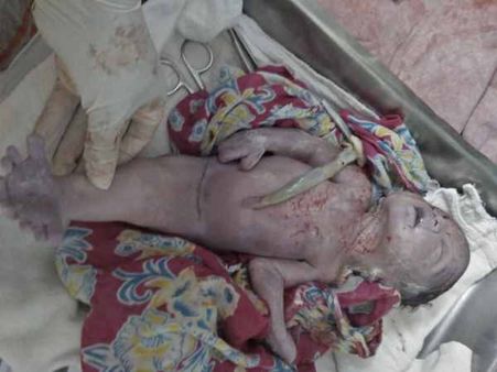 યુપીમાં ‘જલપરી' એ લીધો જન્મ, ડૉક્ટરો પણ આશ્ચર્યચક્તિ