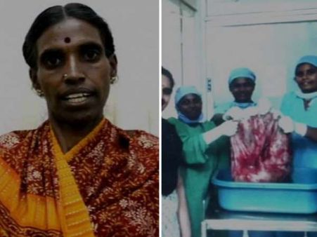 ડોક્ટરોએ મહિલાના પેટમાંથી 33.5 કિલોનું ટ્યુમર કાઢ્યું