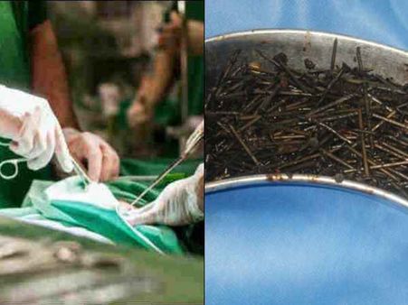 પેટમાં જમા હતુ આટલુ લોખંડ