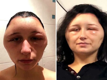 વિજળીના બલ્બ જેવો થઈ ગયો ચહેરો