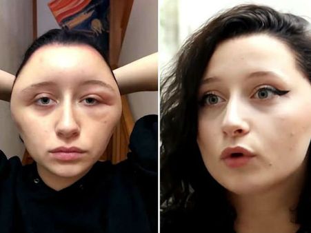 સુંદર દેખાવા યુવતીએ લગાવી હેર ડાય, ‘વિજળીના બલ્બ' જેવો બની ગયો ચહેરો