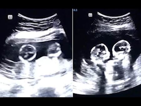 ગર્ભમાં ઉછળતી બાળકીઓના પિતા ખૂબ ખુશ હતા