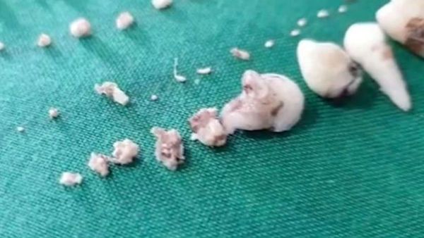 જેનેટિક ડિસઓર્ડર અથવા રેડિએશન હોય શકે છે કારણ જેનેટિક ડિસઓર્ડર અથવા રેડિએશન હોય શકે છે કારણ