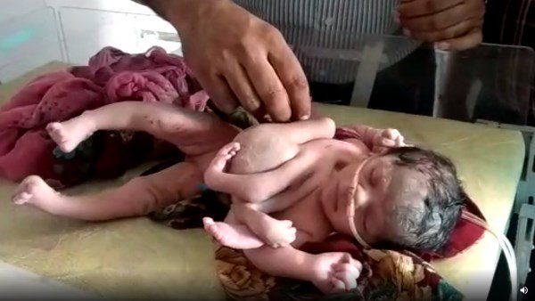 રાજસ્થાનમાં જન્મ્યું 4 હાથ વાળું બાળક, વિચિત્ર બાળકને જોવા લોકોની ભીડ ઉમટી