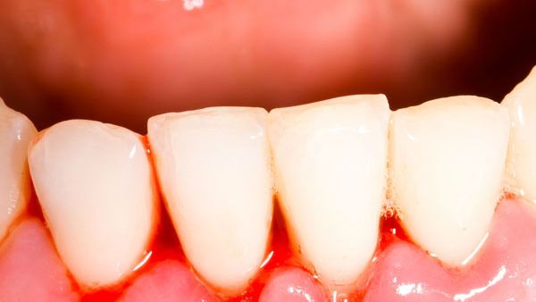 સ્કર્વીને દૂર રાખો