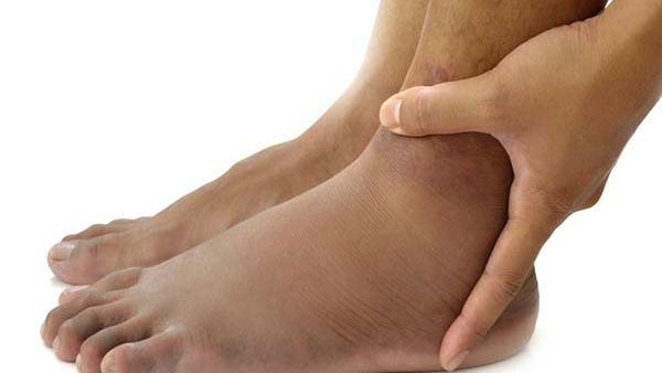 સોજો અને જોડાથી રાહત