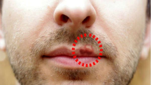 ઓરલ હર્પીસ વાયરલ