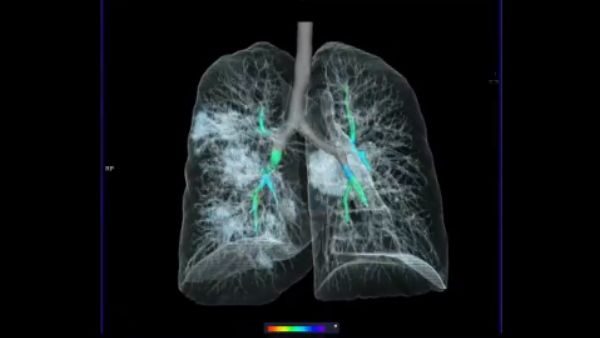 કેવી રીતે જાણી શકાય કે ફેફસા કેટલા સંક્રમિત છે