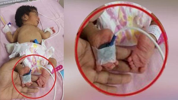 ઉલટા પગવાળી દીકરી જન્મતા લાવારિસ છોડીને જતા રહ્યા માતાપિતા, 36 કલાક પછી પાછા આવ્યા