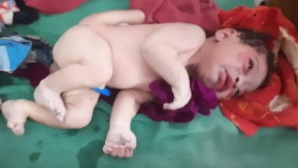 ત્રણ હાથ અને ત્રણ પગ સાથે જન્મેલું બાળક