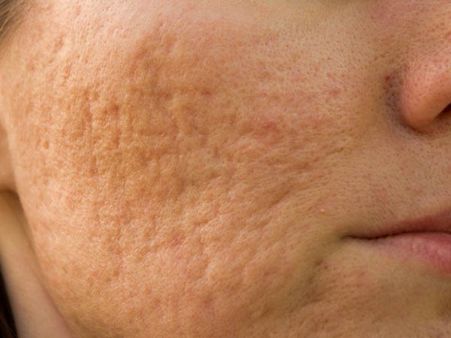 Skin Care Tips : પિમ્પલ્સ અને ખીલની સમસ્યા છે, તો અપનાવો આ અસરકારક ઉપાયો