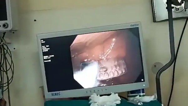 પકડાવાના ડરથી કેદીએ ગળ્યો મોબાઇલ