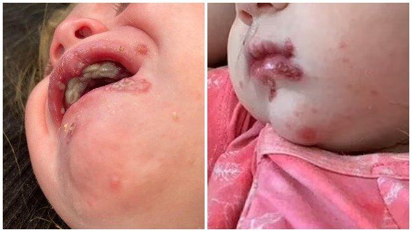 Monkey Pox: શું કોરોના પછી આગલી મહામારી બનશે મંકીપોક્સ વાયરસ? WHOએ કહી આ વાત