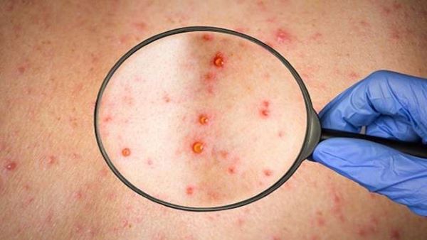 Monkeypox Prevention: મંકીપોક્સનો ખતરો વધ્યો, જાણો આ વાયરસથી કેવી રીતે ખુદને બચાવી શકશો?