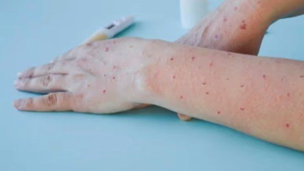 Monkeypox Outbreak: દિલ્લીમાં મંકીપૉક્સનો બીજો કેસ, કોઈ ટ્રાવેલ હિસ્ટ્રી નથી, આરોગ્ય વિભાગ કરશે તપાસ