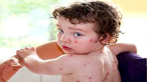 અન્ય સંક્રમણની જેમ અન્ય સંક્રમણની જેમ