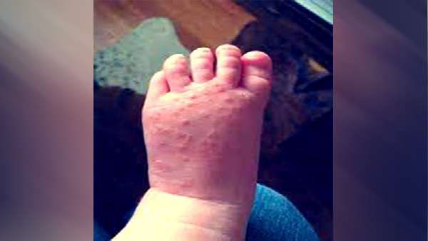 કેવી રીતે કરશો બચાવ કેવી રીતે કરશો બચાવ