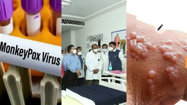 દિલ્હીમાં મંકીપોક્સ: આ હોસ્પિટલોમાં બનાવાયા આઇસોલેશન રૂમ